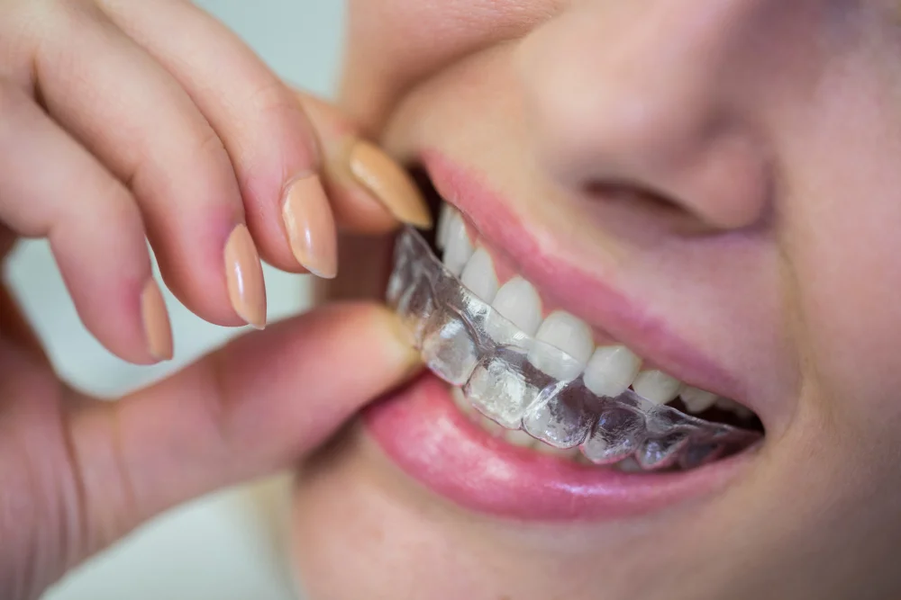 Braces